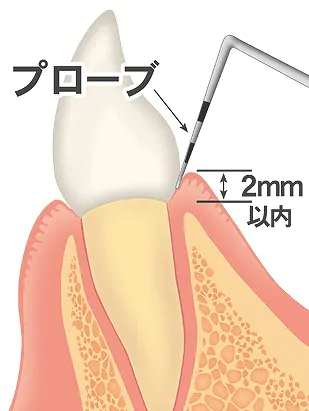 歯周ポケット検査（ブローピング検査）
