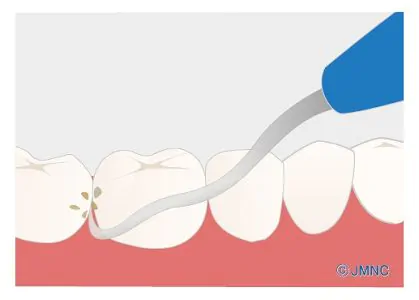 歯石取り（歯石除去）
