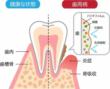 歯周病について