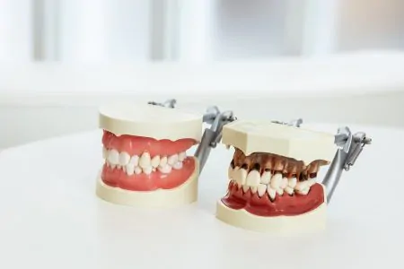 歯周病は自然に完治しません。