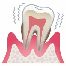重度の歯周病
