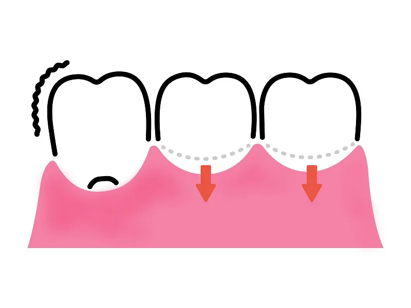 歯ぐきが下がる・痩せる