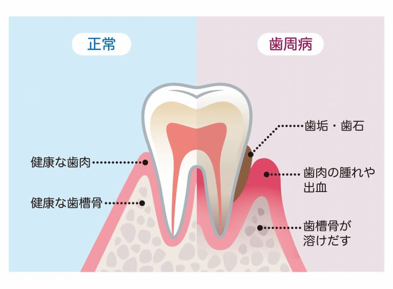 歯周病について