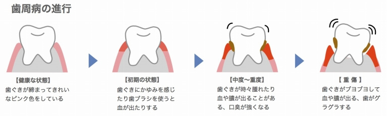 歯周病の原因